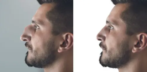 rhinoplasty nose surgery before-after 500