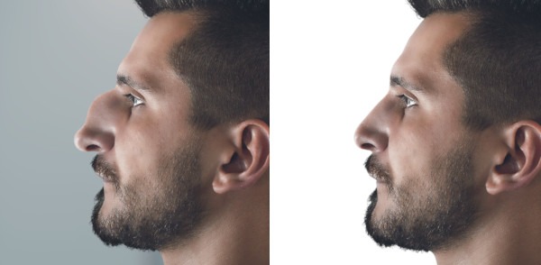 Rhinoplastie chirurgie du nez photo exemple