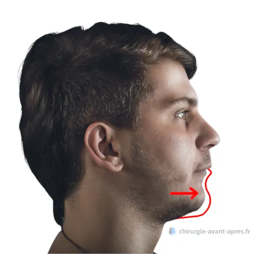 advanced lower jaw male class II orthognathia receding chin