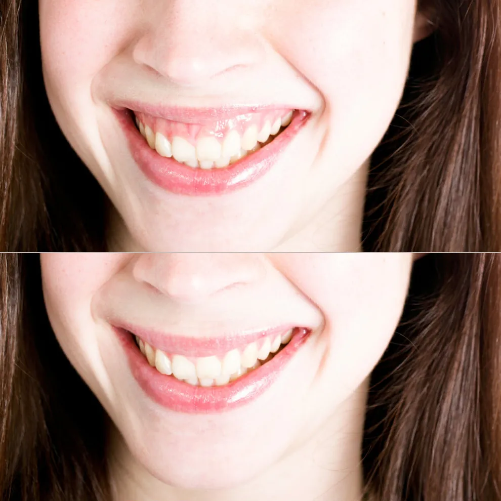 before-after-gummy-smile-surgery