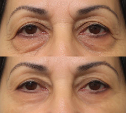 blepharoplasty