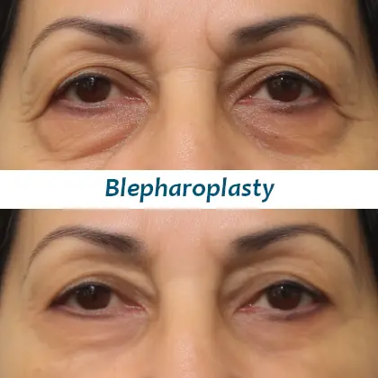 blepharoplasty