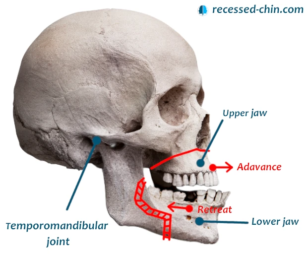 forward jaw prognathism class III surgery