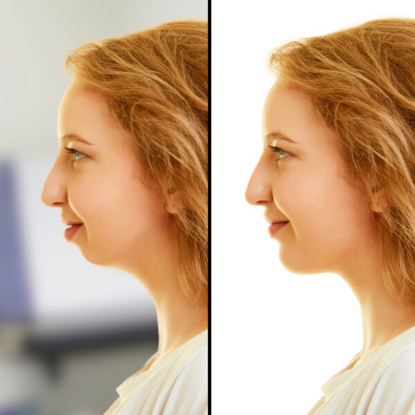 genioplasty chin-wing