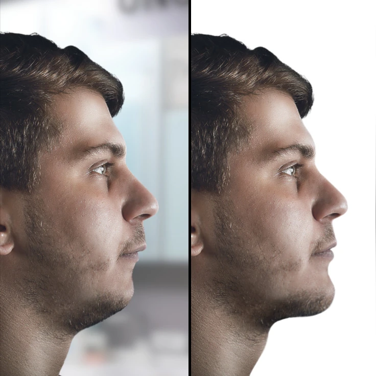 recessed chin skeletal class II malocclusion