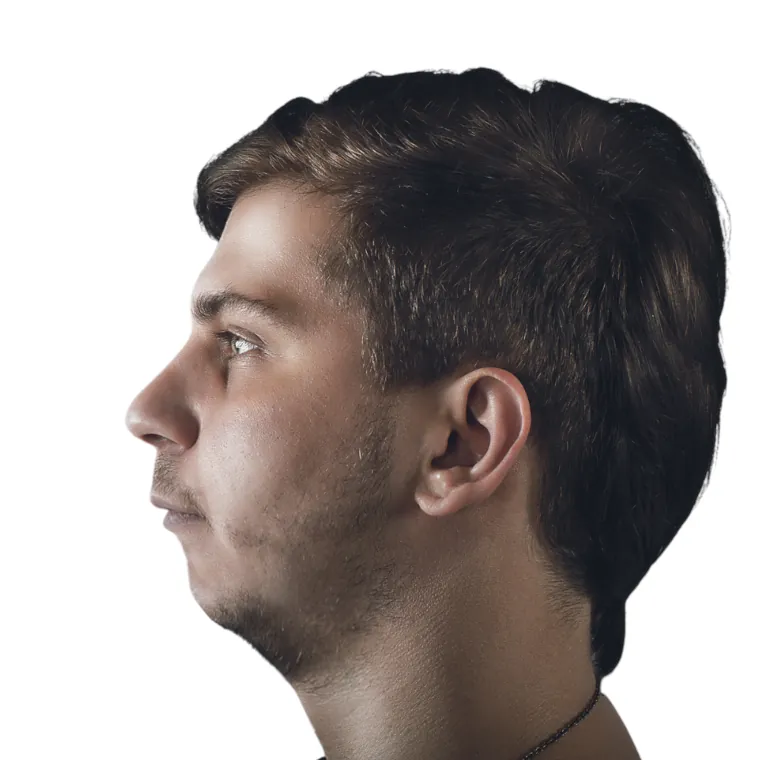 recessed chin