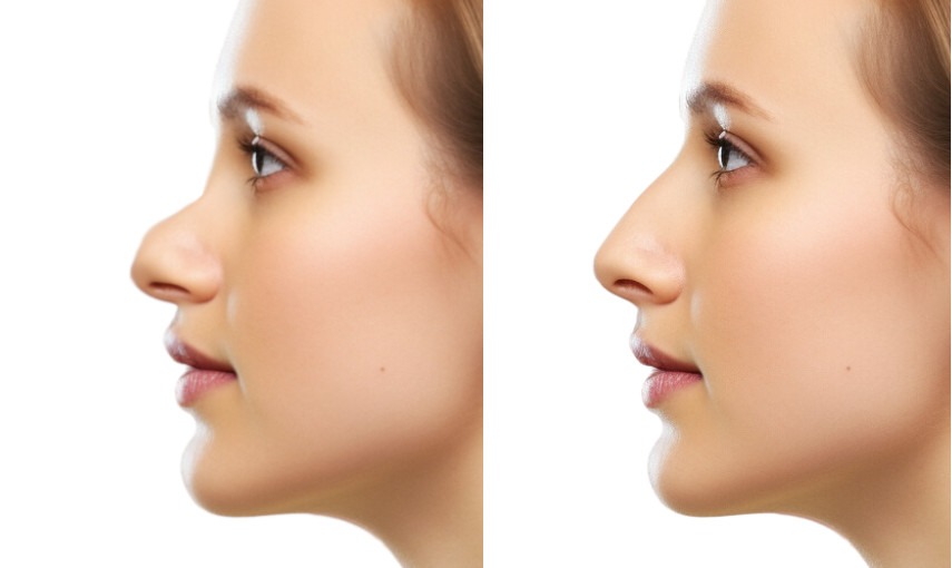 chirurgie esthétique nez camard biscornu