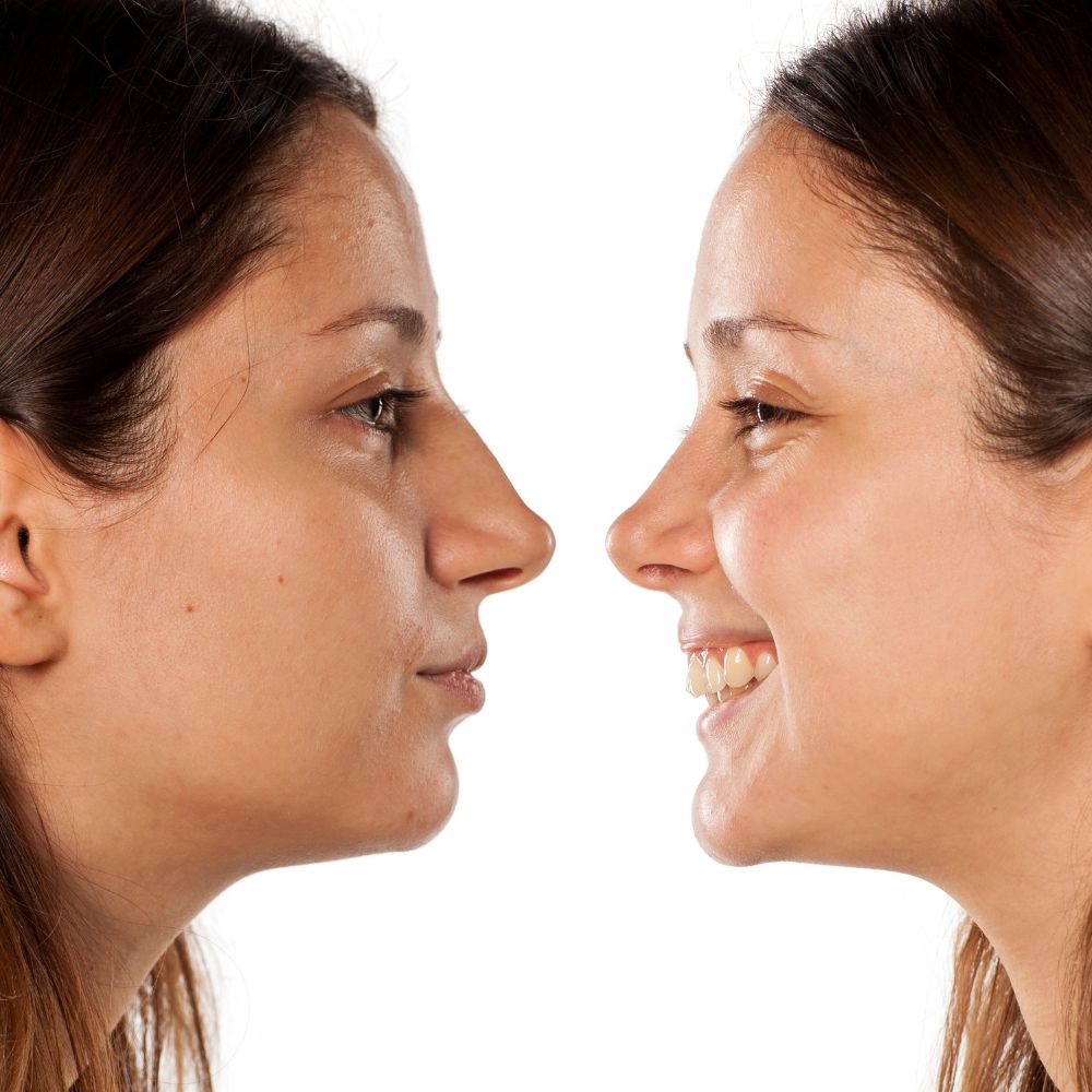 rhinoplasty