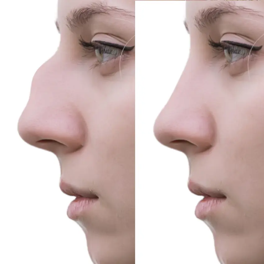 rhinoplasty