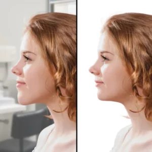 surgery before after-long face big chin