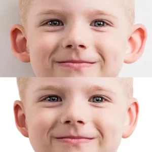 surgery-before-after-otoplasty-protruding-ears