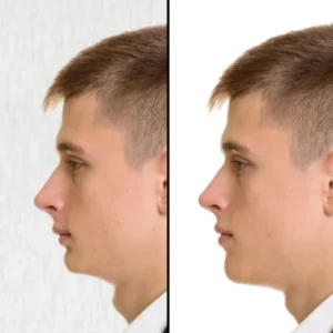 surgery before-after short face small chin removal