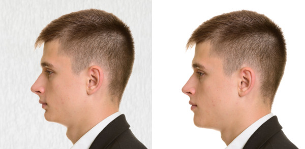 short face surgery vertical-insufficiency