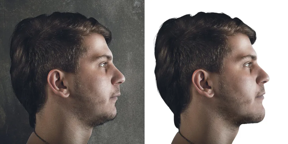 chin advancement simulation