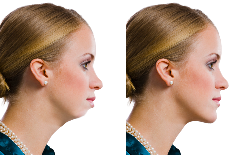 receding chin woman