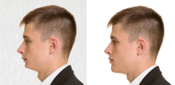short face surgery vertical insufficiency before-after