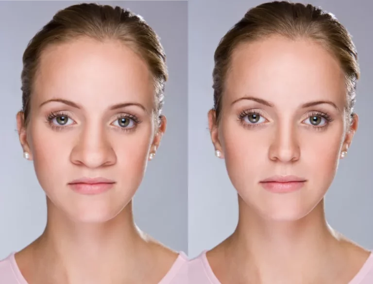 big nose rhinoplasty