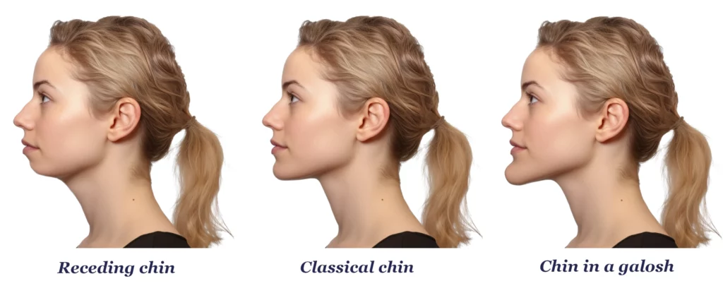 genioplasty