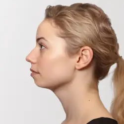 genioplasty chin surgery