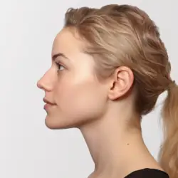 genioplasty chin surgery (8)