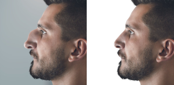 rhinoplasty nose surgery before after