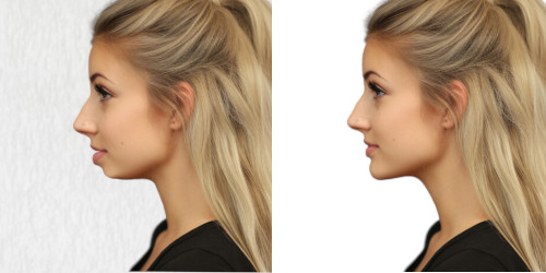 chin receding backward (2)