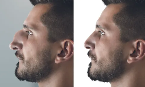medical rhinoplasty injections