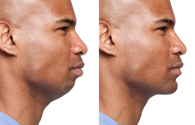 receding chin man