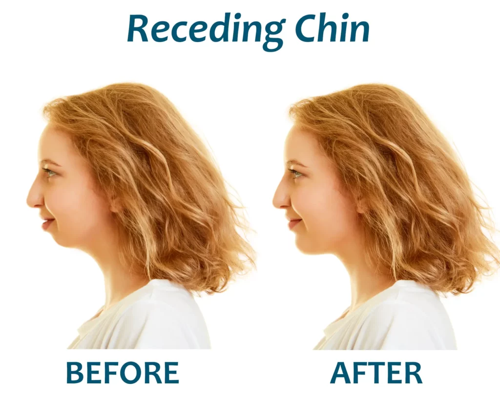 recessed chin jaw before after