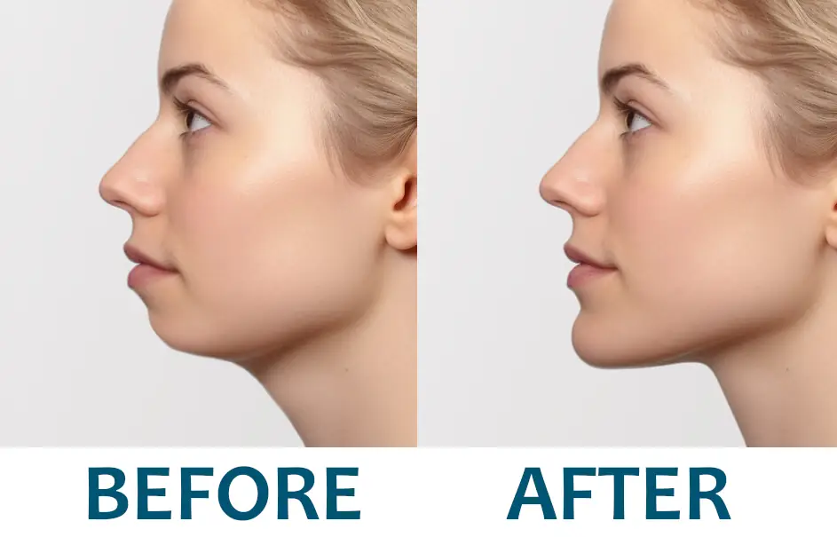 recessed chin simulation