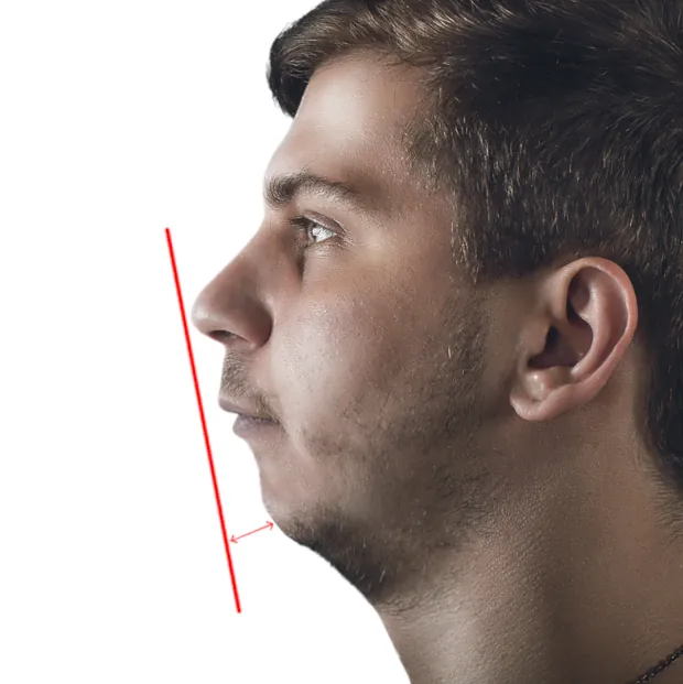 How to know if you have a receding chin