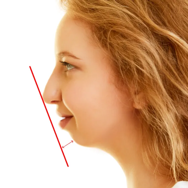 Recessed chin