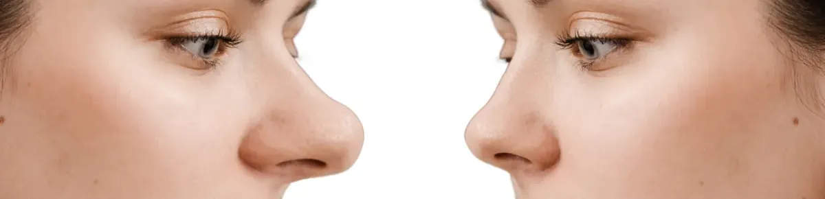 big long nose rhinoplasty (1)