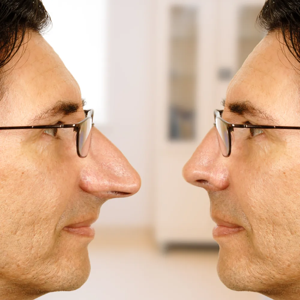 ultrasound rhinoplasty