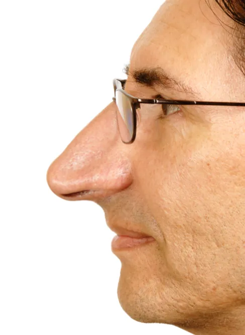 big long nose rhinoplasty (2)