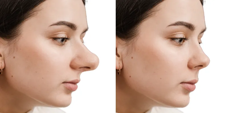 big long nose rhinoplasty (9)