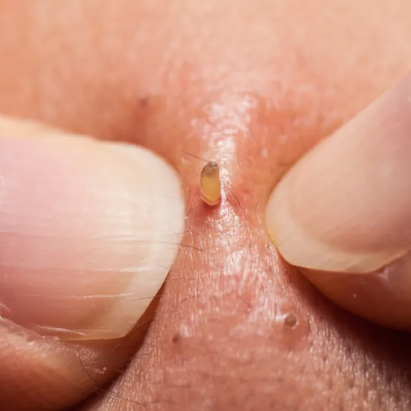 blackheads on the nose