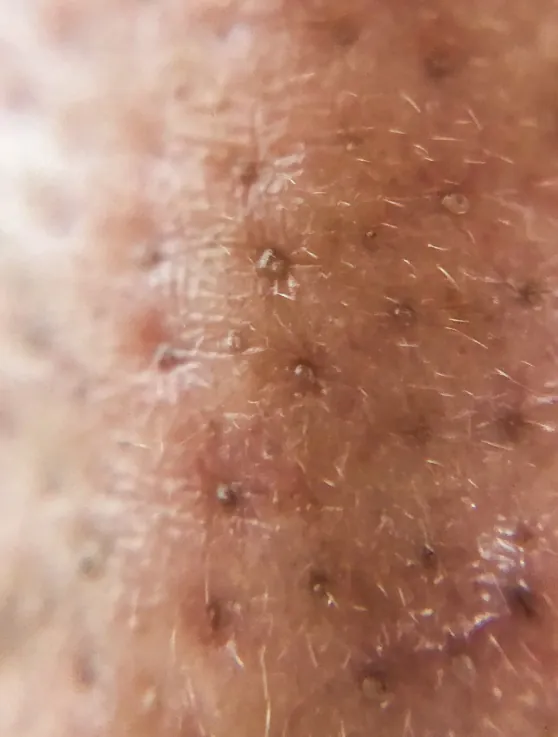 blackheads on the nose (6)