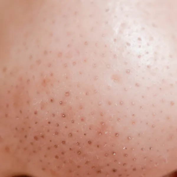 blackheads on the nose