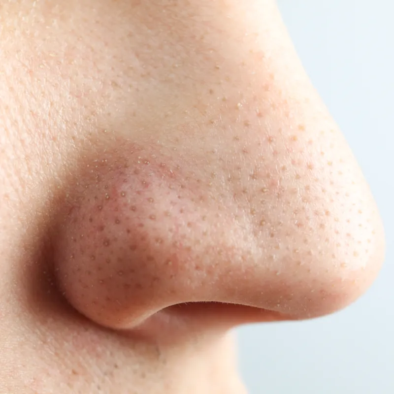 blackheads on the nose