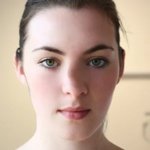 crooked nose rhinoplasty (11)