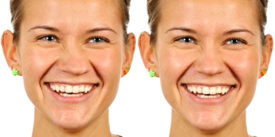 crooked nose rhinoplasty (5)