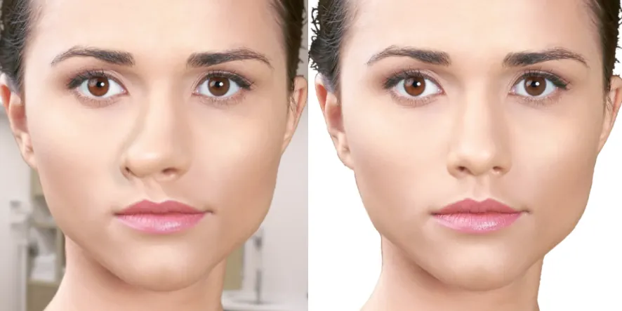 crooked nose rhinoplasty (9)