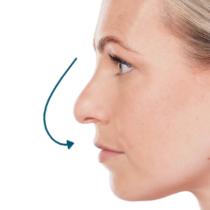 crow s beak nose failed rhinoplasty