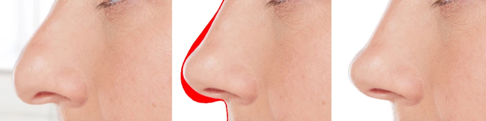 crow s beak nose failed rhinoplasty (7)