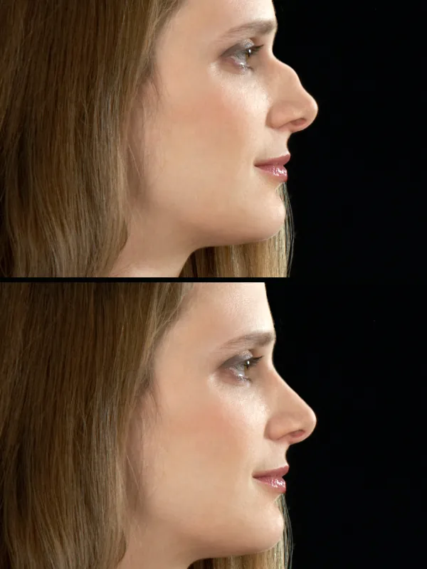 Greek nose rhinoplasty