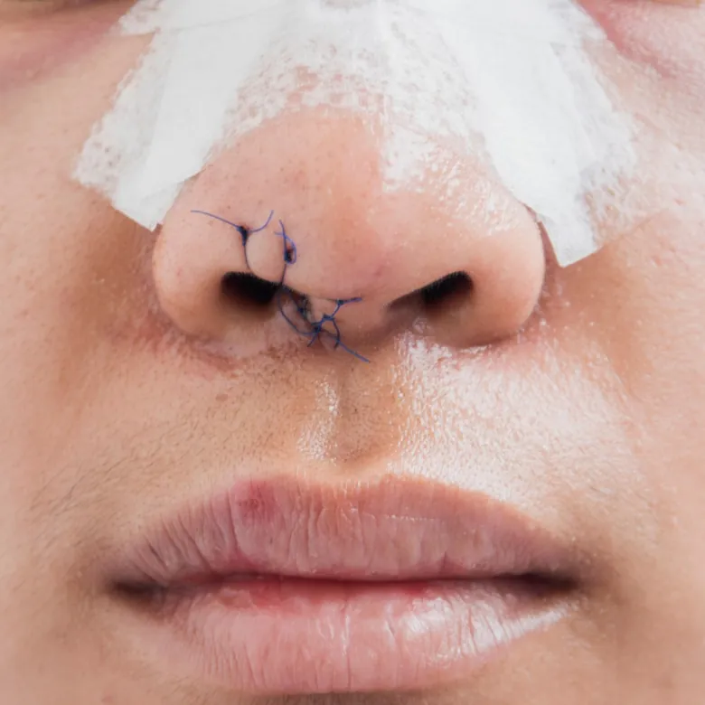 nez chirurgie réparatrice