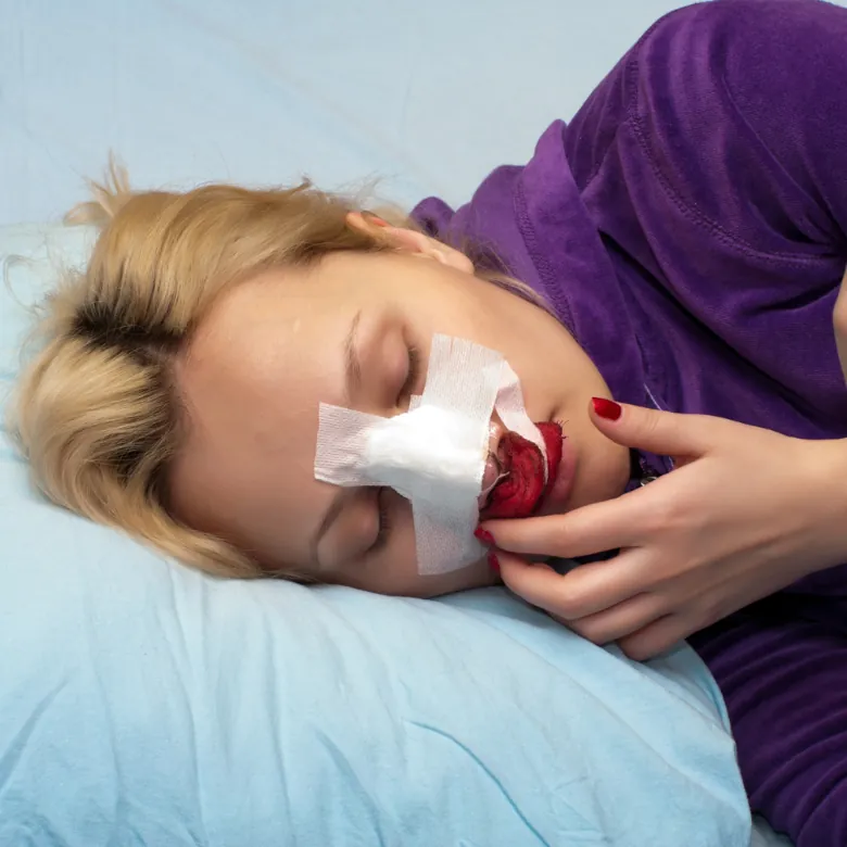 nose plaster rhinoplasty
