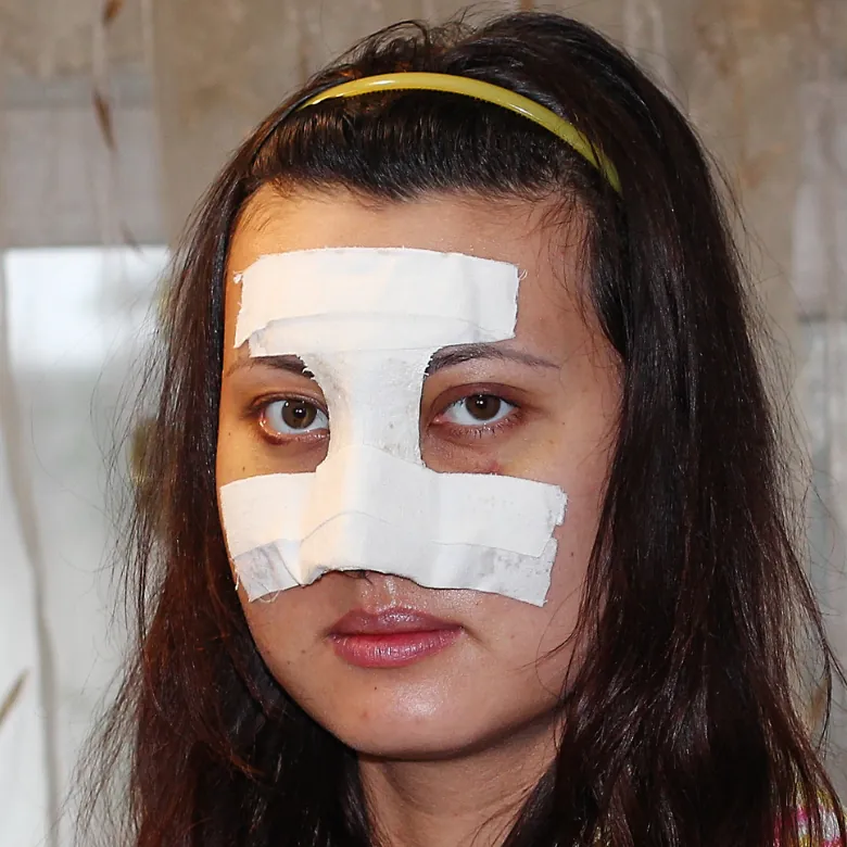 nose plaster rhinoplasty (4)