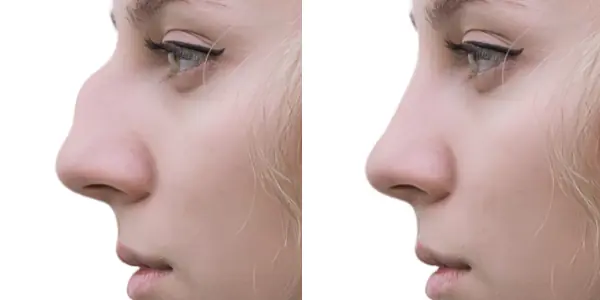nose rhinoplasty